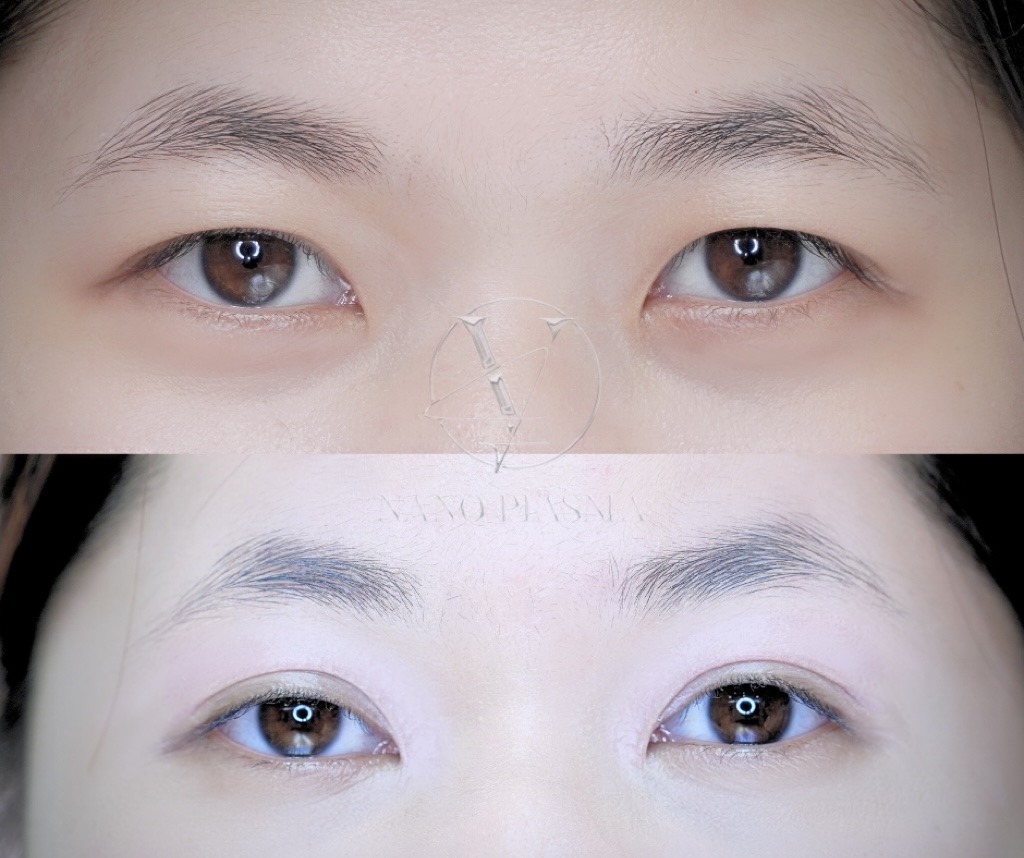 Ảnh Bìa Định Hình Eyelift