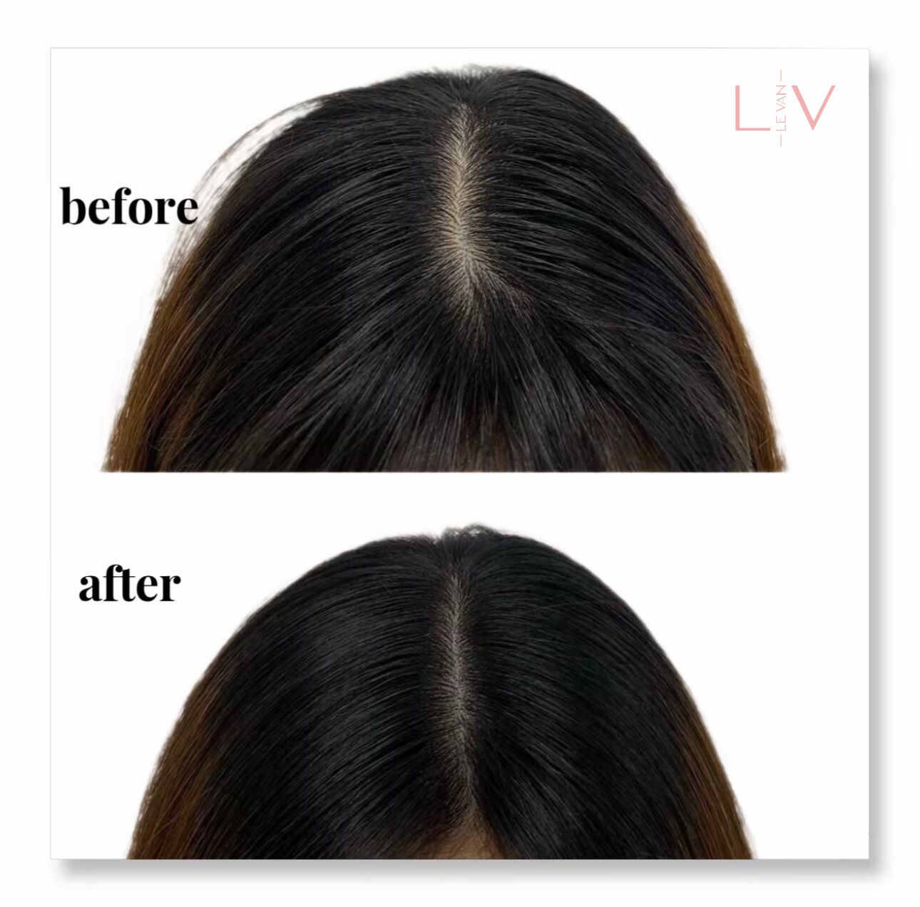 Ảnh Bìa Trị Hói Hyper Hair