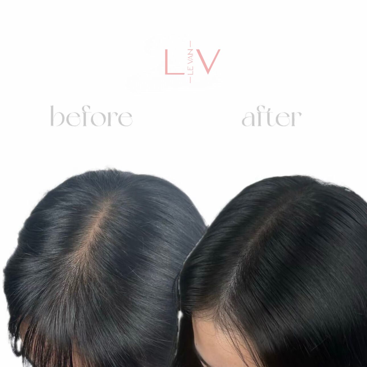 Ảnh Định Hình Healing Plasma 4