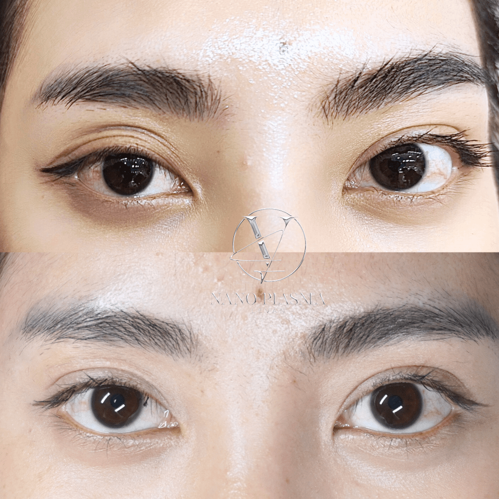 Định Hình Eyelift