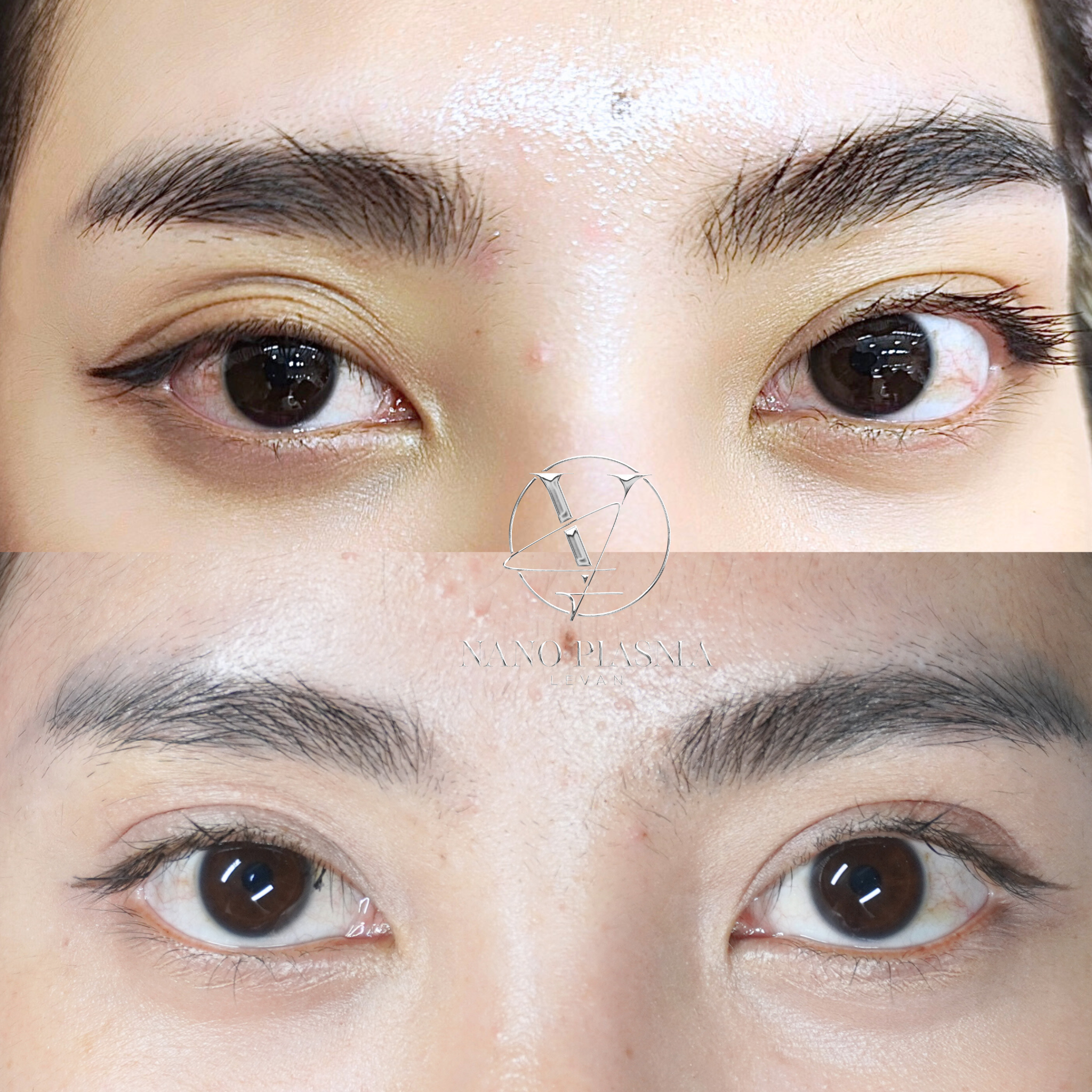 Định Hình Eyelift