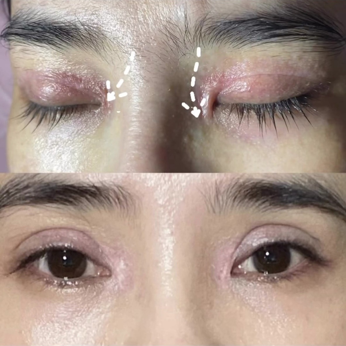 Định hình Eyelift Plasma 2